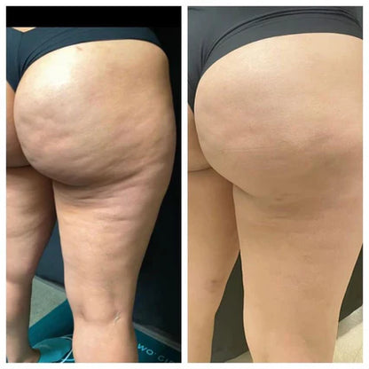 Vellyss™ — Anti-Cellulite en Silicone