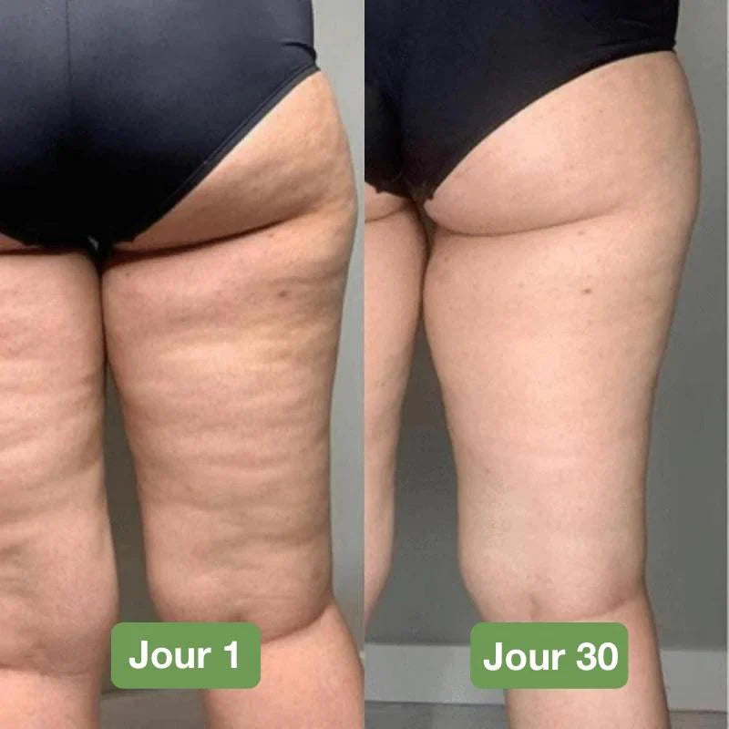 Vellyss™ — Anti-Cellulite en Silicone