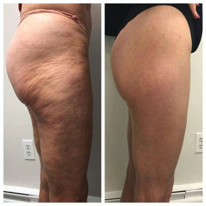 Vellyss™ — Anti-Cellulite en Silicone